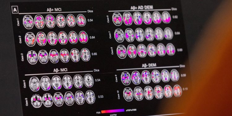 eu-kommission-laesst-neuartigen-alzheimer-wirkstoff-lecanemab-zu