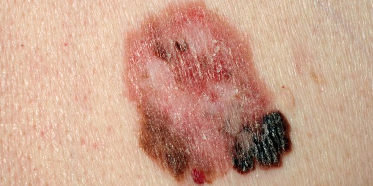 zahl-der-hautkrebsfaelle-hat-sich-fast-verdoppelt