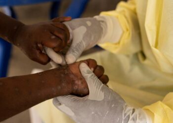 neue-mpox-variante-breitet-sich-in-zentralafrika-aus