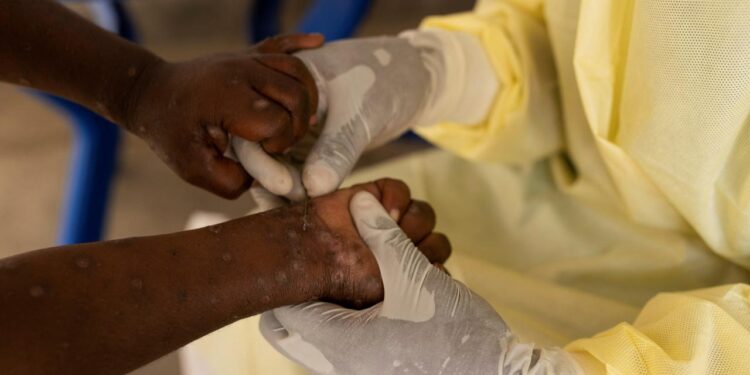neue-mpox-variante-breitet-sich-in-zentralafrika-aus